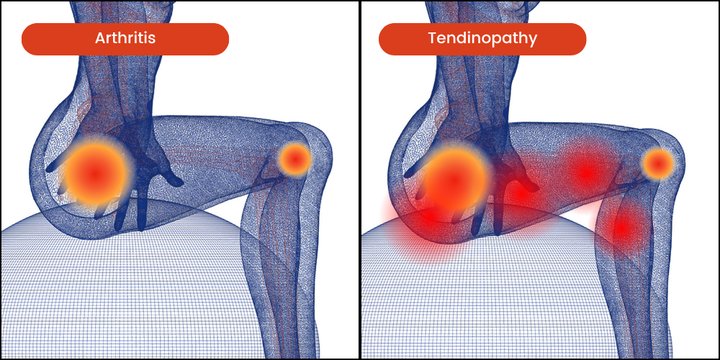 Tendinopathy vs arthritis diagram